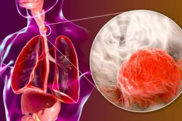 best hospital for treatment of food pipe cancer, best doctor for esophageal cancer surgery, cost of treatment of esophagus or cancer of food pipe, Amritum Hospital mohali punjab india