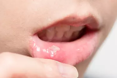 best hospital for mouth cancer treatment in Bhagalpur, best doctor for mouth cancer treatment in Bhagalpur, cost of mouth cancer treatment in Bhagalpur